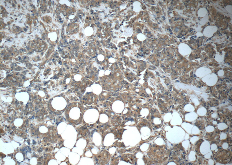 Immunohistochemistry of paraffin-embedded human breast cancer tissue slide using Catalog No:107209(FGFR1 Antibody) at dilution of 1:50 (under 10x lens)