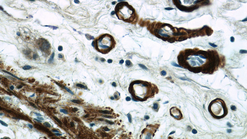 Immunohistochemistry of paraffin-embedded human colon tissue slide using Catalog No:116334(TRANSGELIN-1-specific Antibody) at dilution of 1:200 (under 40x lens)