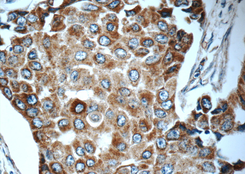 Immunohistochemistry of paraffin-embedded human breast cancer tissue slide using Catalog No:116141(Timp-3 Antibody) at dilution of 1:50 (under 40x lens)