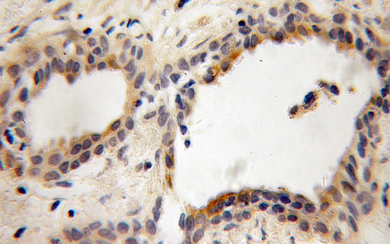 Immunohistochemical of paraffin-embedded human prostate cancer using Catalog No:113837(PITPNB antibody) at dilution of 1:100 (under 10x lens)