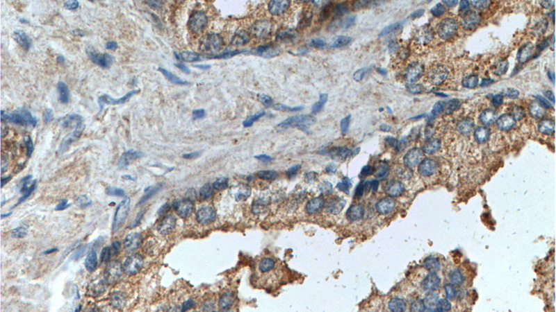 Immunohistochemistry of paraffin-embedded human prostate hyperplasia tissue slide using Catalog No:114269(PTGER4 Antibody) at dilution of 1:200 (under 40x lens).
