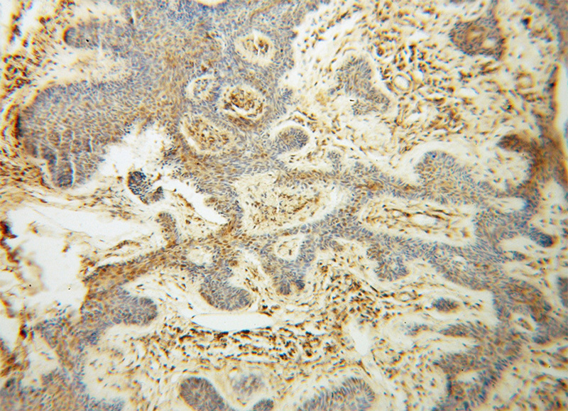 Immunohistochemical of paraffin-embedded human skin cancer using Catalog No:110866(GAR1 antibody) at dilution of 1:50 (under 10x lens)