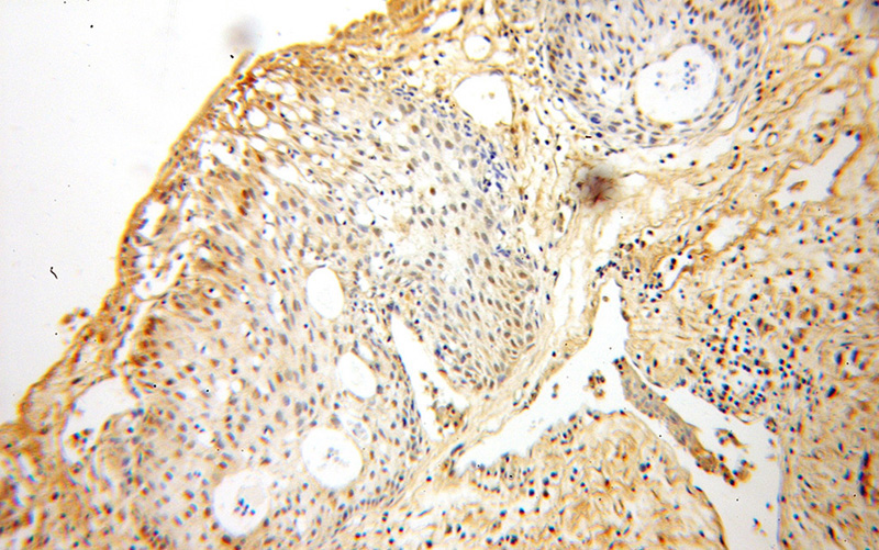 Immunohistochemical of paraffin-embedded human prostate cancer using Catalog No:110451(FAF1 antibody) at dilution of 1:50 (under 10x lens)