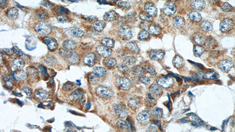 Immunohistochemistry of paraffin-embedded human breast cancer tissue slide using Catalog No:112612(MICB Antibody) at dilution of 1:50 (under 40x lens)