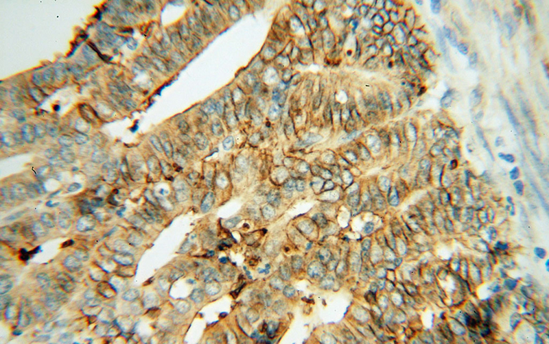 Immunohistochemical of paraffin-embedded human endometrial cancer using Catalog No:116042(THEM4 antibody) at dilution of 1:50 (under 40x lens)