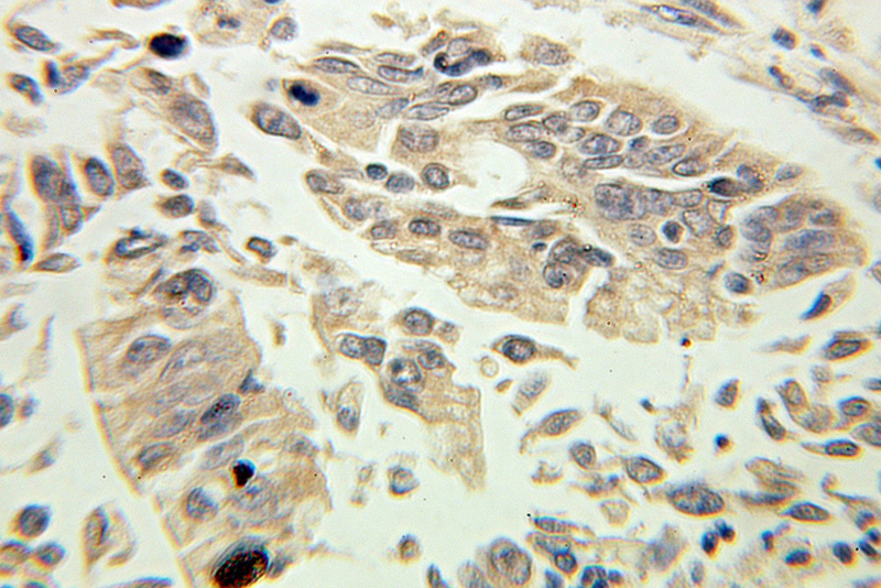 Immunohistochemical of paraffin-embedded human pancreas cancer using Catalog No:111901(KLK1 antibody) at dilution of 1:100 (under 40x lens)