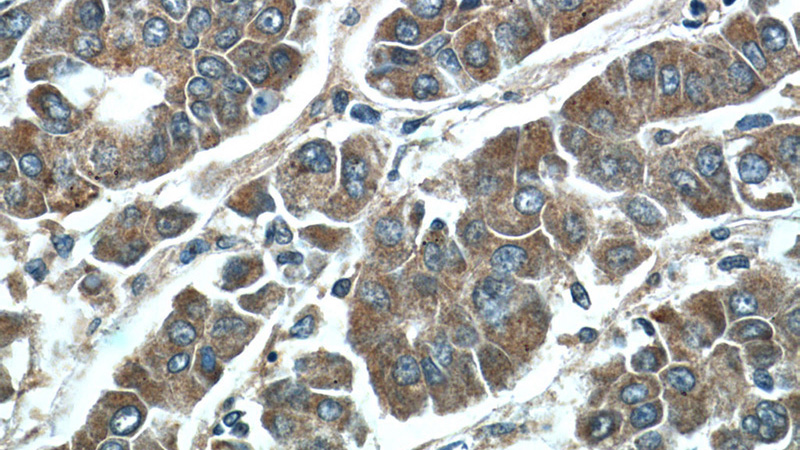 Immunohistochemistry of paraffin-embedded human liver cancer tissue slide using Catalog No:111825(IQGAP2 Antibody) at dilution of 1:50 (under 40x lens)