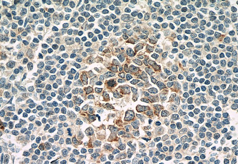 Immunohistochemistry of paraffin-embedded human tonsillitis tissue slide using (IL21R Antibody) at dilution of 1:100 (under 40x lens)