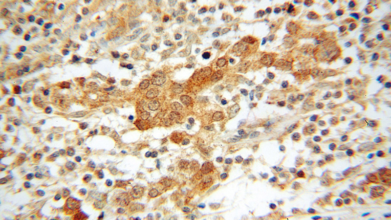 Immunohistochemical of paraffin-embedded human breast cancer using Catalog No:110979(GIPC1 antibody) at dilution of 1:100 (under 40x lens)