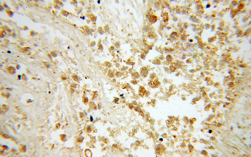 Immunohistochemical of paraffin-embedded human lung cancer using Catalog No:117218(BPIL1 antibody) at dilution of 1:100 (under 40x lens)