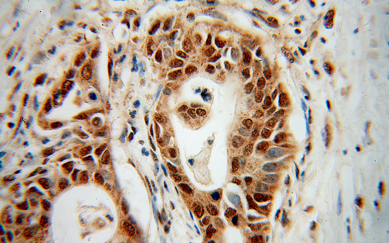 Immunohistochemical of paraffin-embedded human pancreas cancer using Catalog No:114817(RPL17 antibody) at dilution of 1:100 (under 40x lens)