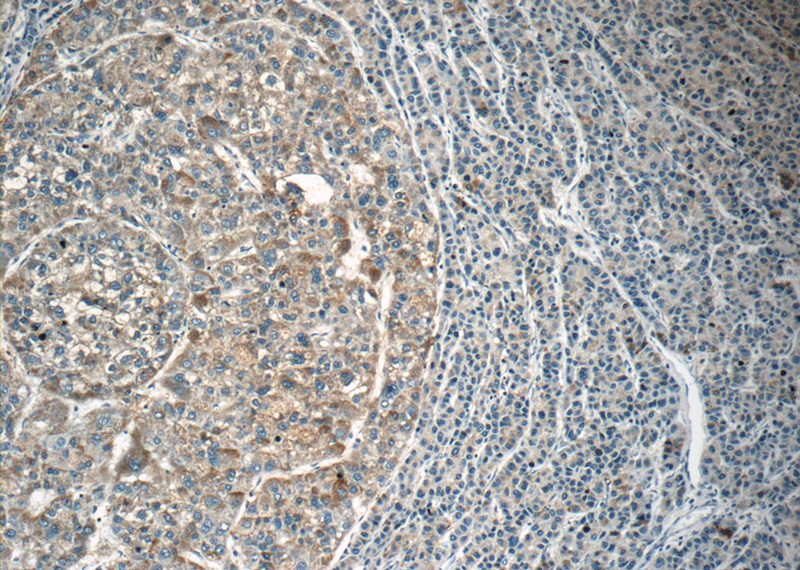 Immunohistochemistry of paraffin-embedded human liver cancer tissue slide using Catalog No:112143(LAPTM4B Antibody) at dilution of 1:50 (under 10x lens)