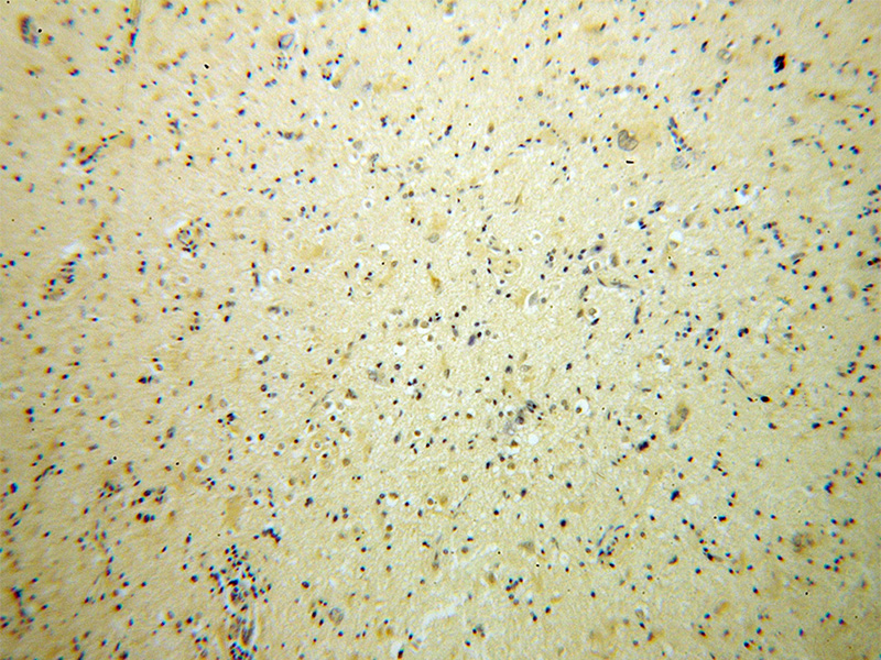 Immunohistochemical of paraffin-embedded human gliomas using Catalog No:117246(BRUNOL5 antibody) at dilution of 1:50 (under 10x lens)