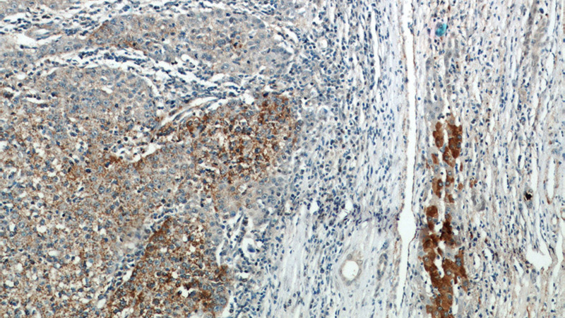 Immunohistochemical of paraffin-embedded human liver cancer using Catalog No:113872(PIK3CB antibody) at dilution of 1:50 (under 10x lens)