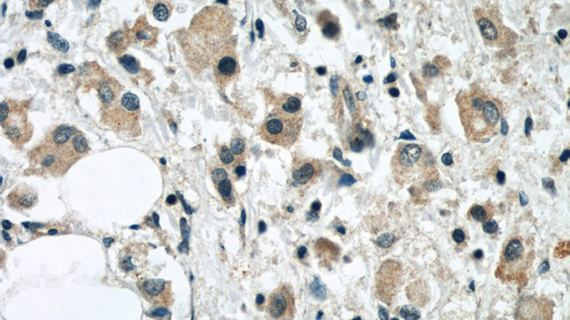 Immunohistochemical of paraffin-embedded human breast cancer using Catalog No:115805(SYTL2 antibody) at dilution of 1:50 (under 40x lens)