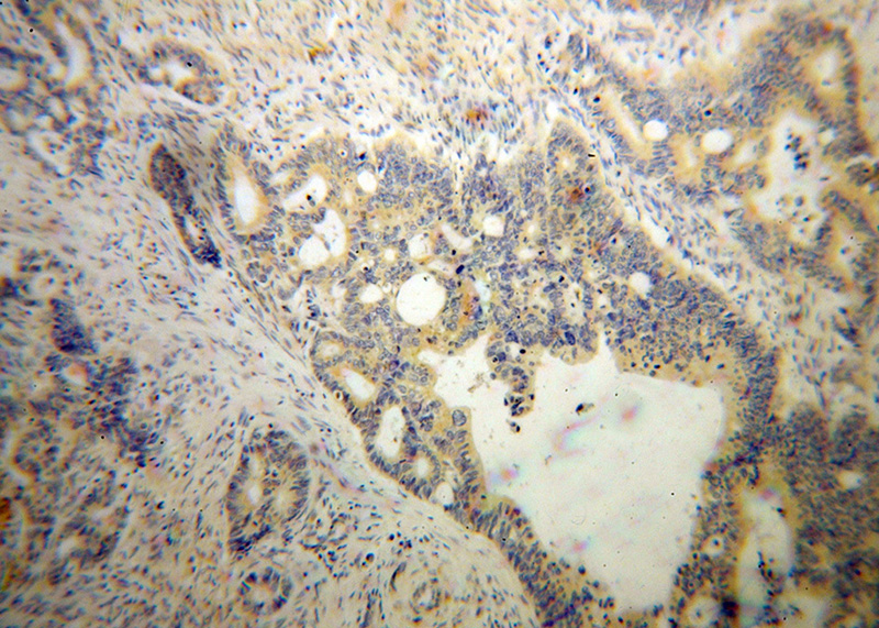 Immunohistochemical of paraffin-embedded human liver cancer using Catalog No:109864(DAPP1 antibody) at dilution of 1:100 (under 10x lens)