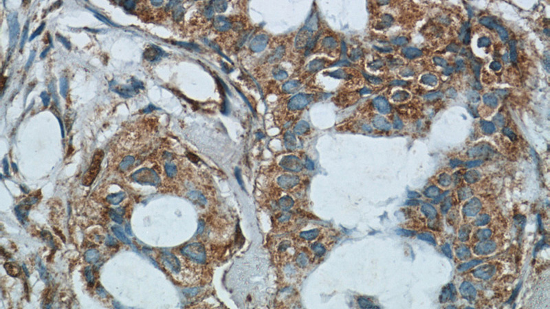 Immunohistochemistry of paraffin-embedded human breast cancer tissue slide using Catalog No:107933(AKAP4 Antibody) at dilution of 1:50 (under 40x lens)