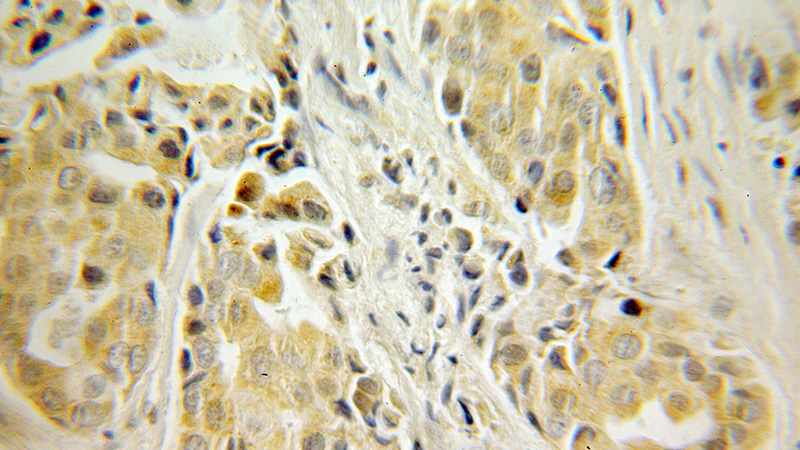 Immunohistochemical of paraffin-embedded human breast cancer using Catalog No:115451(SNCB antibody) at dilution of 1:10 (under 10x lens)