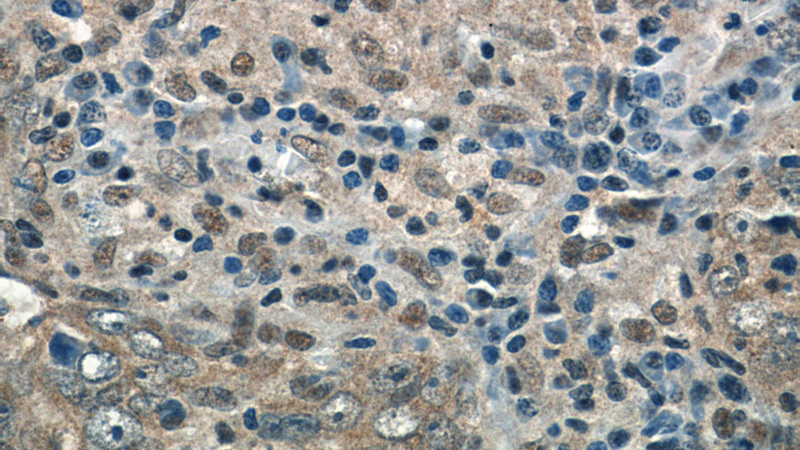 Immunohistochemistry of paraffin-embedded human breast cancer tissue slide using Catalog No:111057(GPATCH2 Antibody) at dilution of 1:50 (under 40x lens)