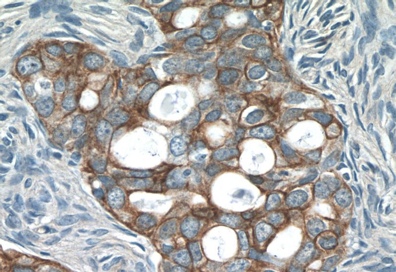Immunohistochemistry of paraffin-embedded human ovary tumor tissue slide using Catalog No:109342(Claudin 4-specific Antibody) at dilution of 1:50 (under 40x lens)
