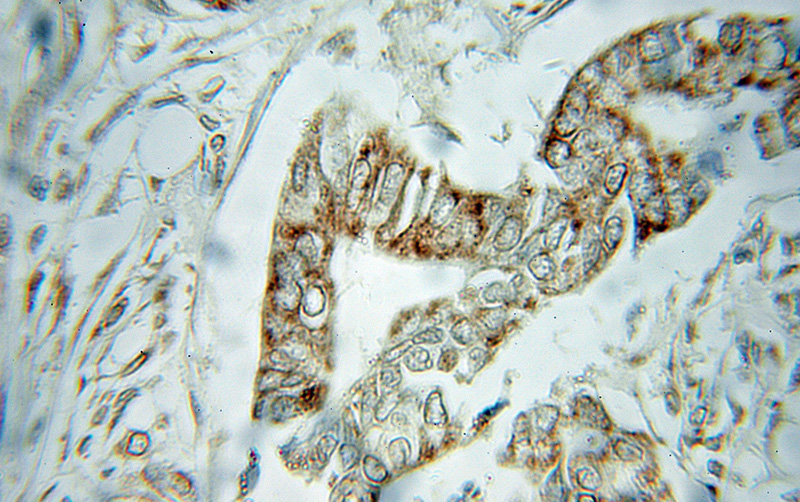 Immunohistochemical of paraffin-embedded human pancreas cancer using Catalog No:117345(VDAC1 antibody) at dilution of 1:50 (under 10x lens)