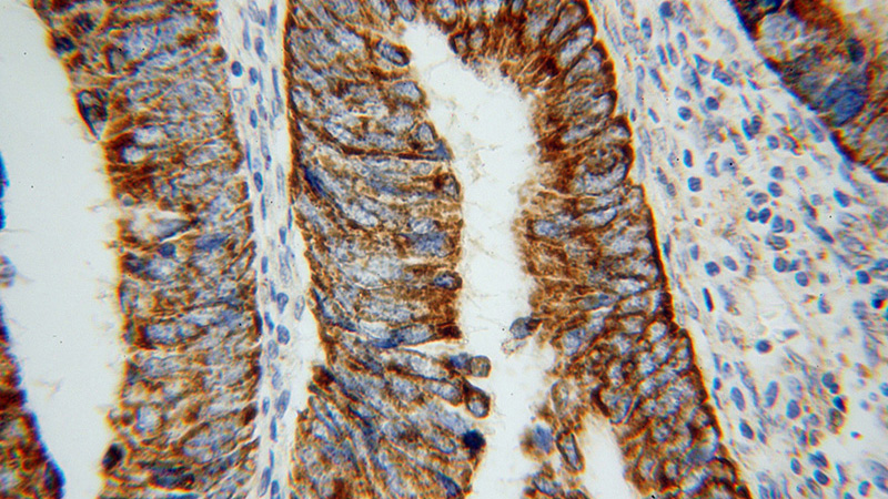 Immunohistochemical of paraffin-embedded human colon cancer using Catalog No:116373(TST antibody) at dilution of 1:50 (under 40x lens)