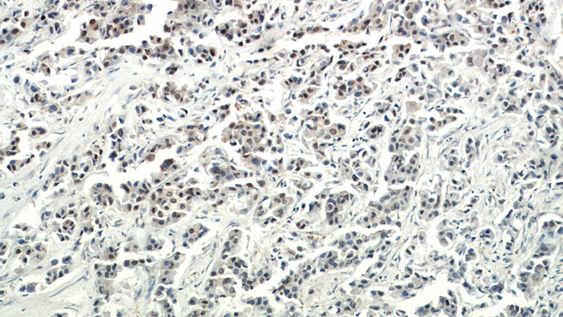 Immunohistochemical of paraffin-embedded human breast cancer using Catalog No:109730(CTR9 antibody) at dilution of 1:200 (under 10x lens)