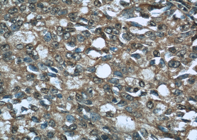 Immunohistochemistry of paraffin-embedded human prostate cancer tissue slide using Catalog No:109732(C1QTNF1 Antibody) at dilution of 1:50 (under 40x lens)