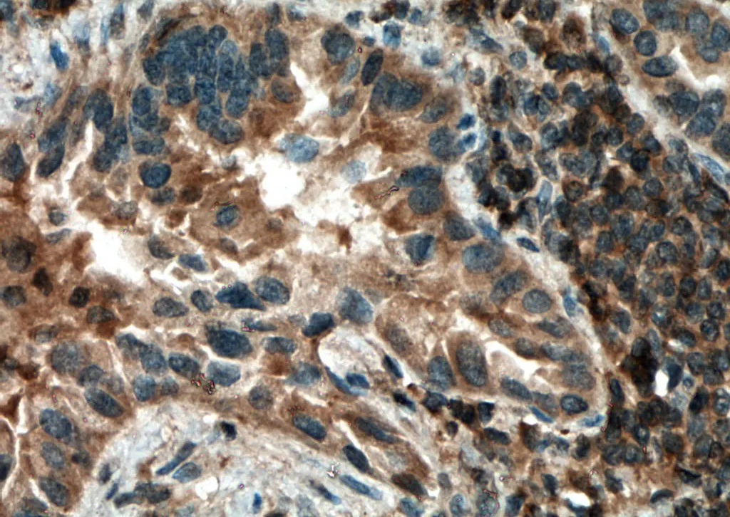 IHC staining of human lung cancer using anti-IRAK4 (111829)
