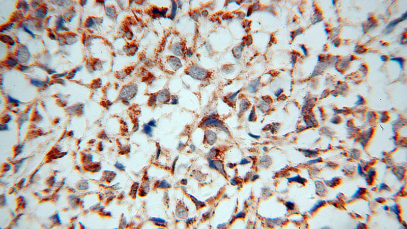 Immunohistochemical of paraffin-embedded human osteosarcoma using Catalog No:108357(ATP5J antibody) at dilution of 1:100 (under 40x lens)