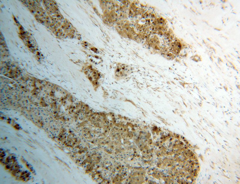 Immunohistochemical of paraffin-embedded human liver cancer using Catalog No:111189(GSTO1 antibody) at dilution of 1:100 (under 10x lens)