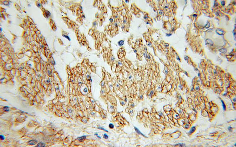 Immunohistochemical of paraffin-embedded human colon cancer using Catalog No:108097(ANXA6 antibody) at dilution of 1:100 (under 40x lens)