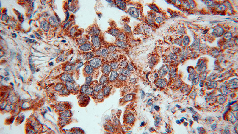 Immunohistochemical of paraffin-embedded human lung cancer using Catalog No:112120(KRAS-2A-specific antibody) at dilution of 1:50 (under 40x lens)