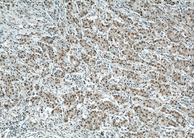 Immunohistochemical of paraffin-embedded human stomach cancer using Catalog No:109167(CDK8 antibody) at dilution of 1:50 (under 10x lens)