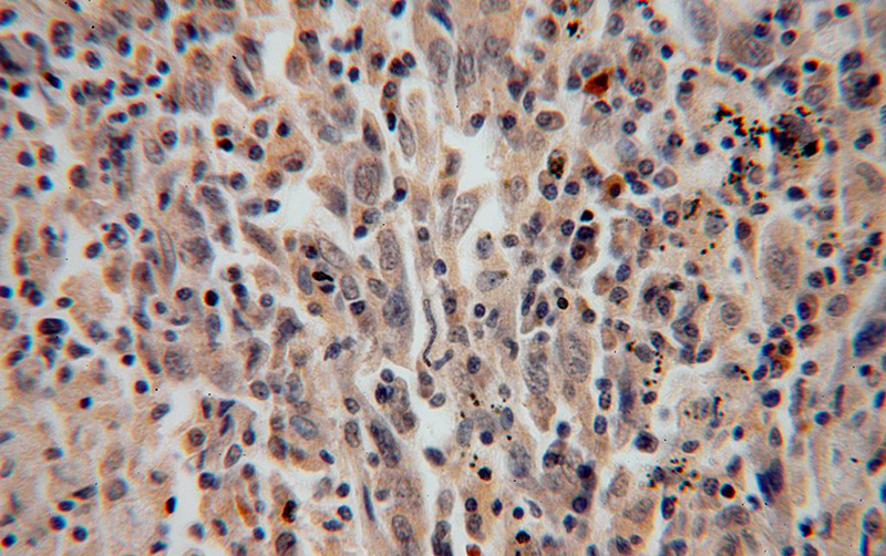 Immunohistochemical of paraffin-embedded human lung cancer using Catalog No:109831(DDX43 antibody) at dilution of 1:100 (under 40x lens)