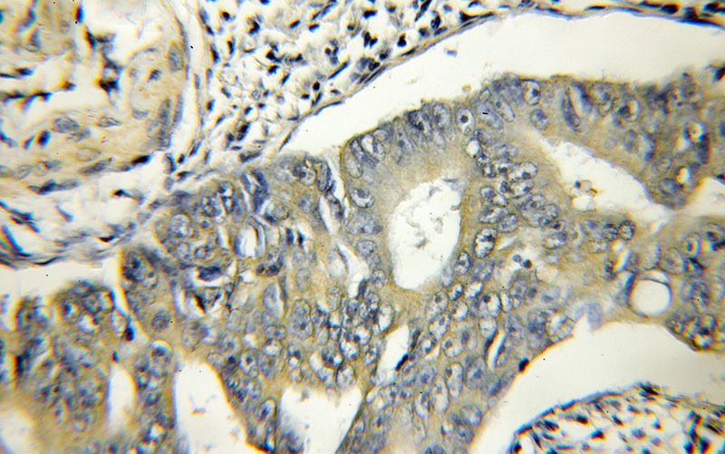 Immunohistochemical of paraffin-embedded human colon cancer using Catalog No:116427(TSFM antibody) at dilution of 1:50 (under 10x lens)