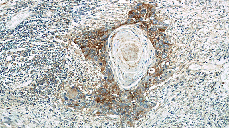 Immunohistochemistry of paraffin-embedded human cervical cancer tissue slide using Catalog No:109663(CCNB2 Antibody) at dilution of 1:200 (under 10x lens)
