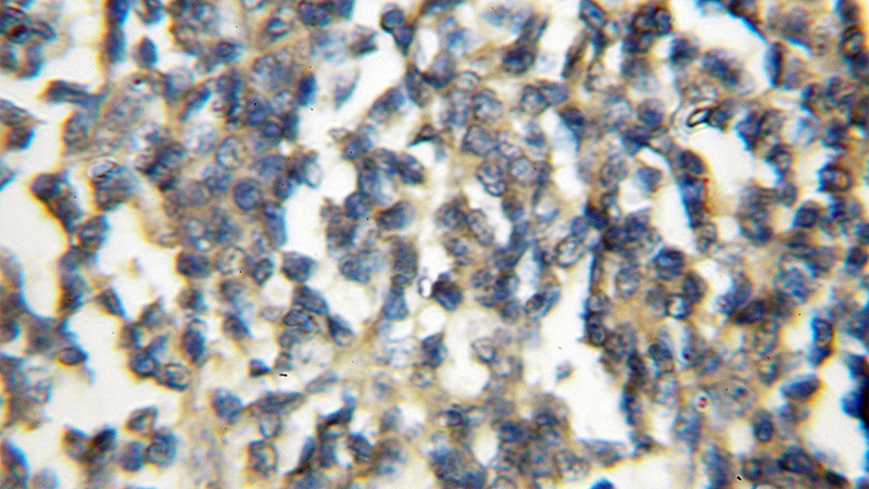Immunohistochemical of paraffin-embedded human lymphoma using Catalog No:116311(TRIM32 antibody) at dilution of 1:50 (under 10x lens)