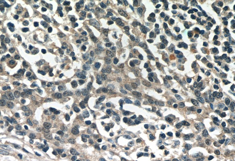 Immunohistochemistry of paraffin-embedded human tonsillitis slide using Catalog No:116246(TOP2A Antibody) at dilution of 1:50