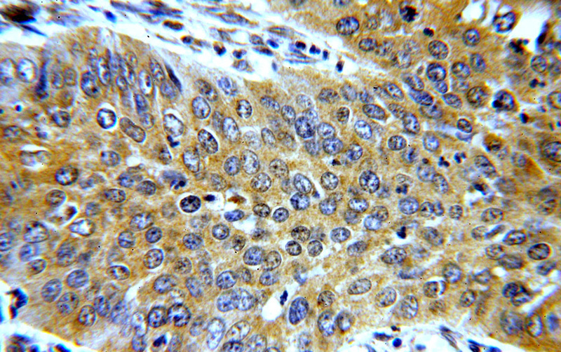 Immunohistochemical of paraffin-embedded human cervical cancer using Catalog No:116203(TMF1-Specific antibody) at dilution of 1:100 (under 40x lens)