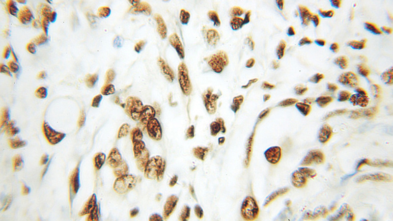 Immunohistochemical of paraffin-embedded human pancreas cancer using Catalog No:111370(HDAC1 antibody) at dilution of 1:100 (under 10x lens)