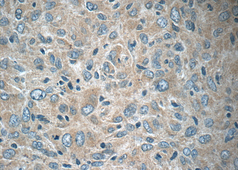 Immunohistochemistry of paraffin-embedded human gliomas tissue slide using Catalog No:113038(NAP1;NCKAP1 Antibody) at dilution of 1:50 (under 40x lens)