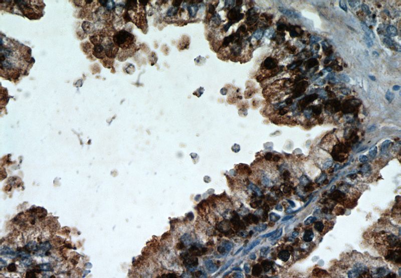 Immunohistochemical of paraffin-embedded human prostate hyperplasia using Catalog No:108965(CCDC153 antibody) at dilution of 1:50 (under 40x lens)