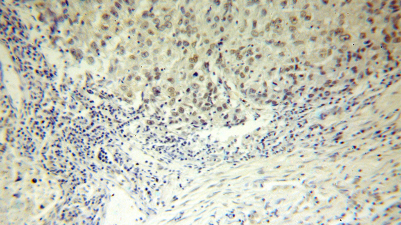 Immunohistochemical of paraffin-embedded human lung cancer using Catalog No:111468(HS1BP3 antibody) at dilution of 1:100 (under 10x lens)