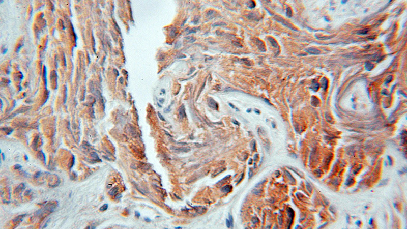 Immunohistochemical of paraffin-embedded human prostate cancer using Catalog No:108890(CTSF antibody) at dilution of 1:100 (under 10x lens)