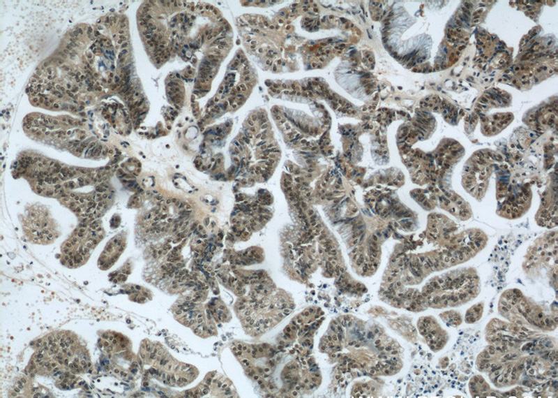 Immunohistochemical of paraffin-embedded human ovary tumor using Catalog No:116964(ZNF24 antibody) at dilution of 1:50 (under 10x lens)