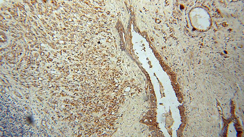 Immunohistochemical of paraffin-embedded human prostate cancer using Catalog No:113500(PAK4 antibody) at dilution of 1:100 (under 10x lens)