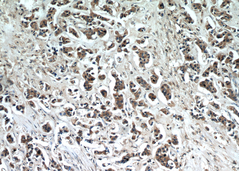 Immunohistochemical of paraffin-embedded human breast cancer using Catalog No:116384(TTC39A antibody) at dilution of 1:50 (under 10x lens)