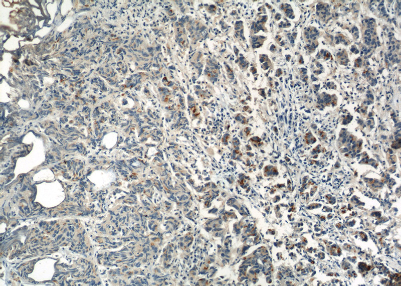 Immunohistochemistry of paraffin-embedded human prostate cancer slide using Catalog No:107472(PIK3R1 Antibody) at dilution of 1:50