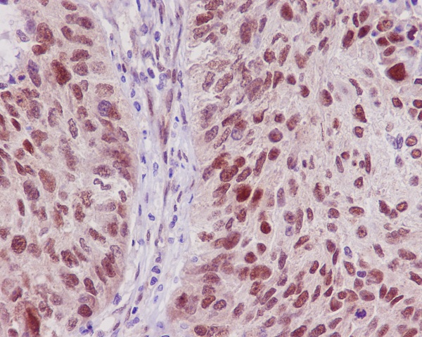 Immunohistochemical analysis of paraffin-embedded human lung carcinoma, using TRAF6 Antibody.